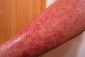 Skin infections